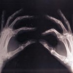 bone loss bone loss